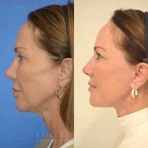 Before and after deep plane facelift — 60-year-old woman, left profile view, 12mo post-op by Dr. Eric Cerrati