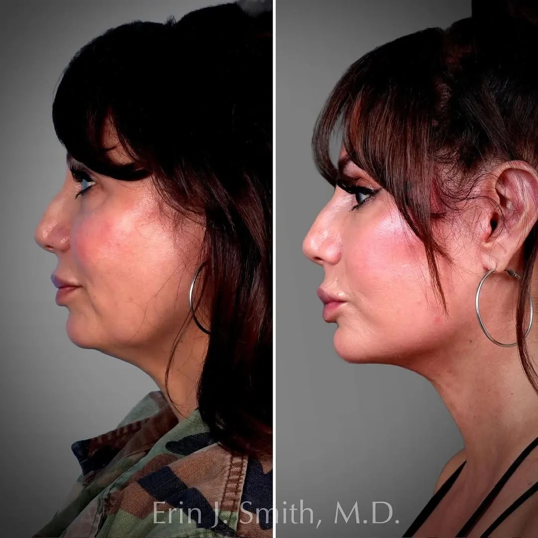 Before and after deep plane facelift — 65-year-old woman, right profile view, 6mo post-op by Dr. Erin Smith