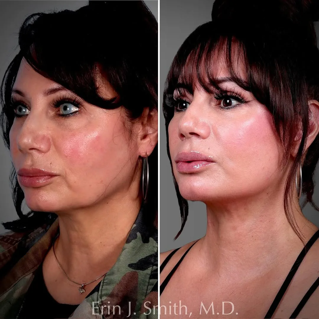 Before and after deep plane facelift — 65-year-old woman, oblique right view, 6mo post-op by Dr. Erin Smith