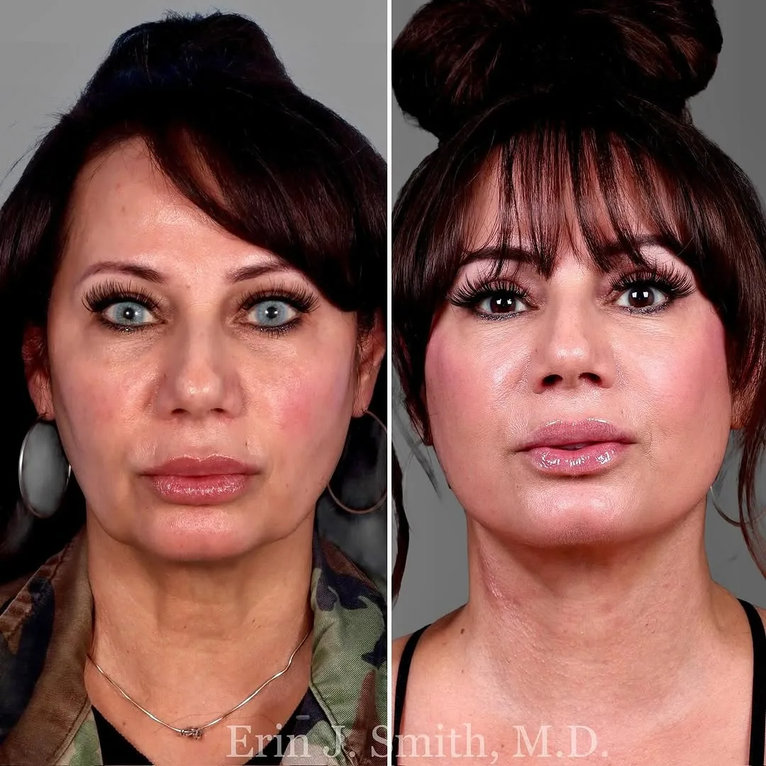 Before and after deep plane facelift — 65-year-old woman, frontal view, 7mo post-op by Dr. Erin Smith