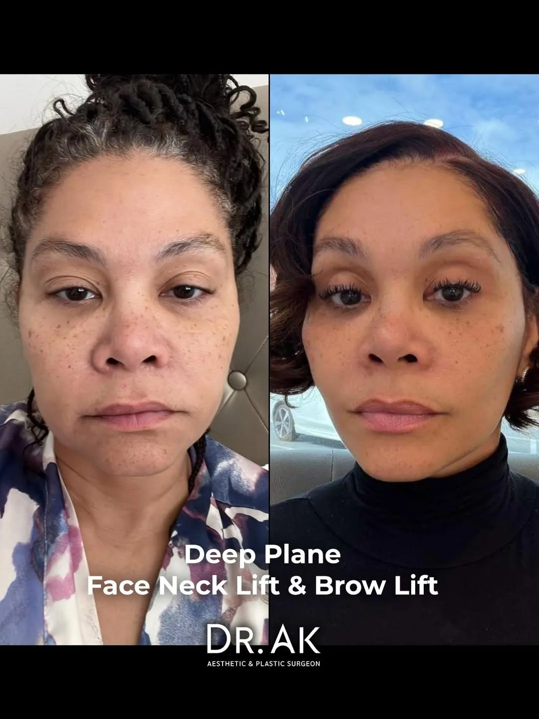 Before and after deep plane facelift — 45-year-old woman, frontal view, 6mo post-op by Dr. Erman Ak