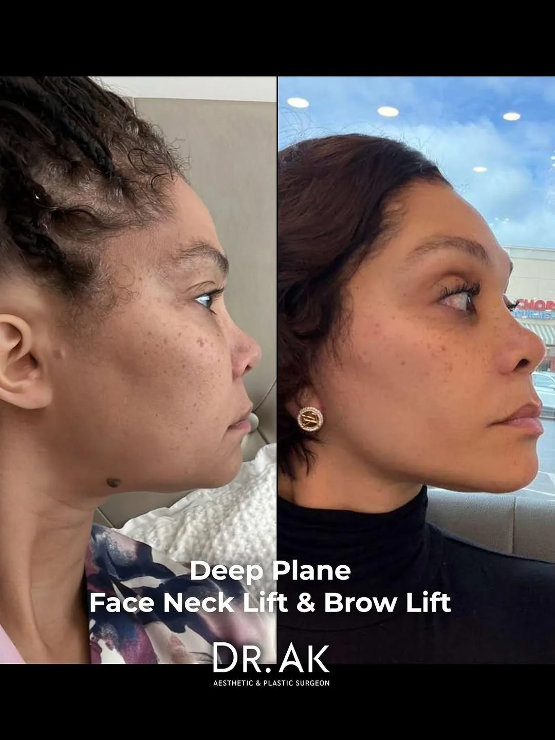 Before and after deep plane facelift — 32-year-old woman, right profile view, 6mo post-op by Dr. Erman Ak