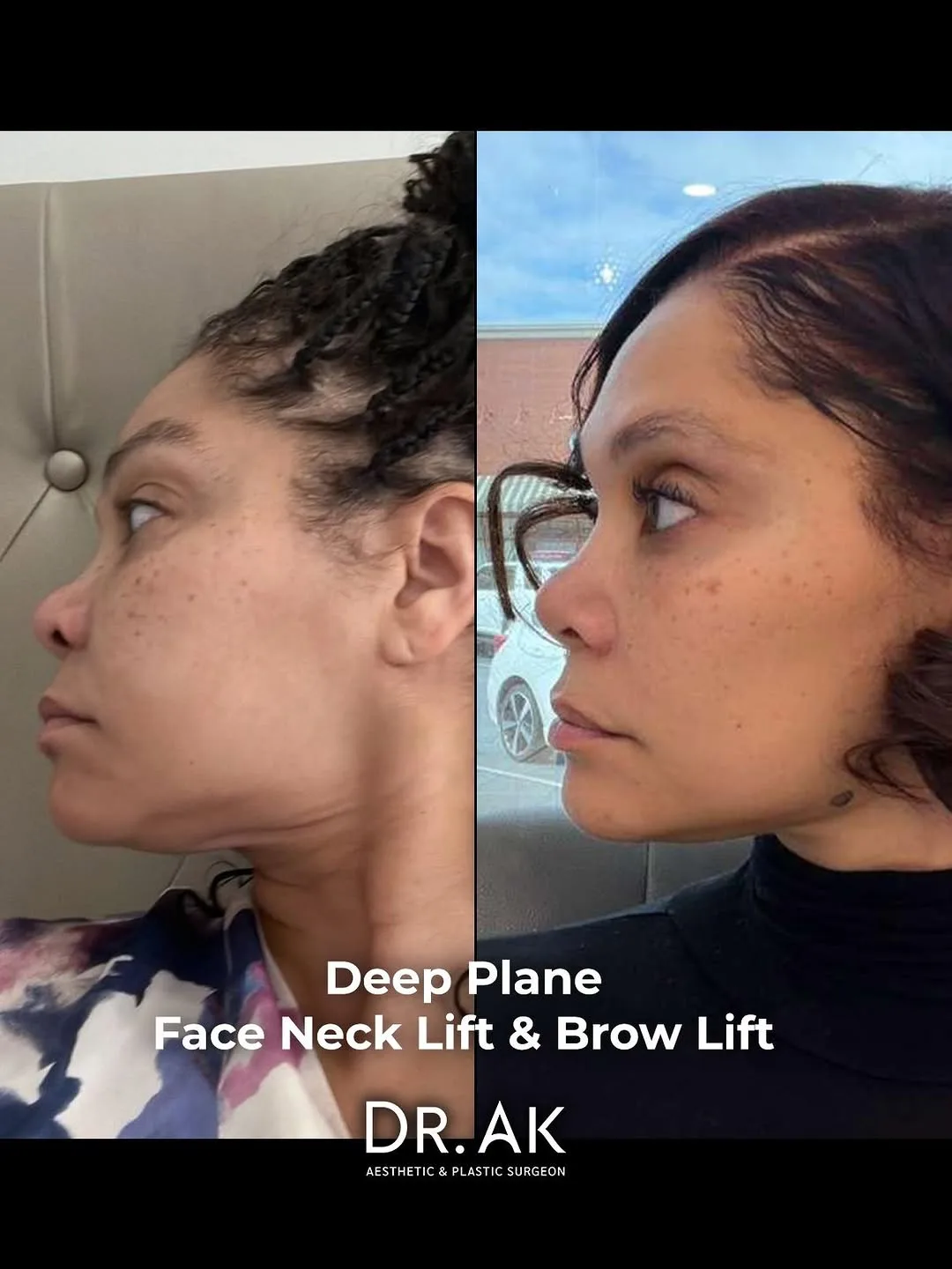 Before and after deep plane facelift — 35-year-old woman, oblique right view, 6mo post-op by Dr. Erman Ak