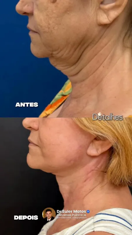 Before and after deep plane facelift, frontal view by Dr. Euler Matos