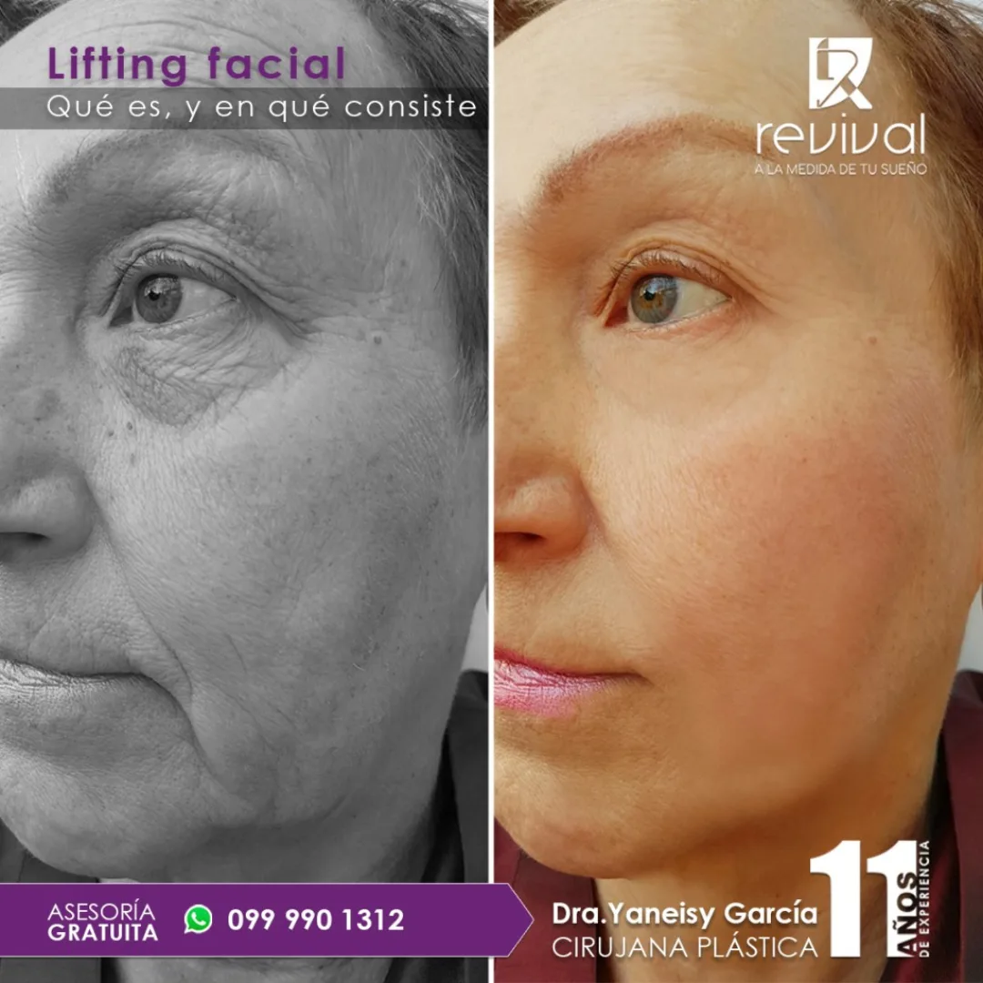 Before and after: Dr. Evelyn Lisseth Alvarracin Vinueza