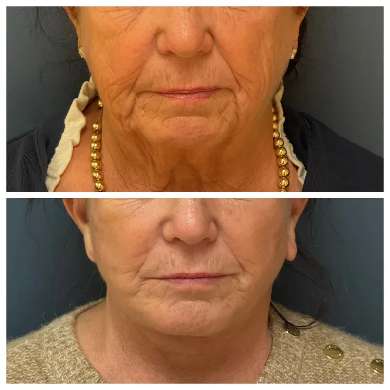 Before and after: Dr. Farhad Rafizadeh