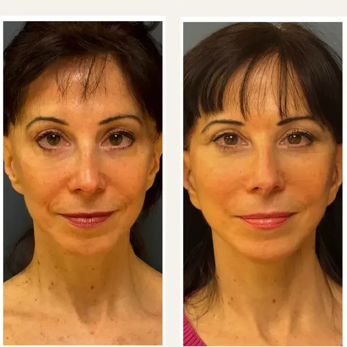Before and after: Dr. Farhad Rafizadeh