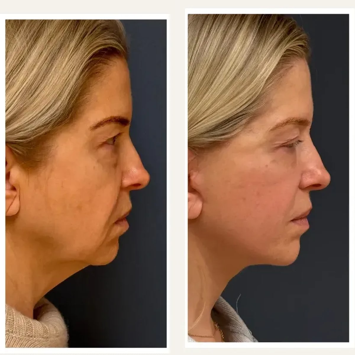 Before and after: Dr. Farhad Rafizadeh