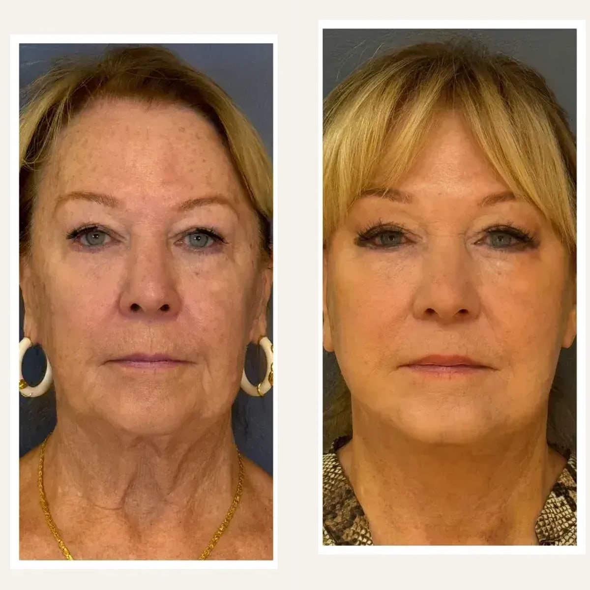 Before and after: Dr. Farhad Rafizadeh