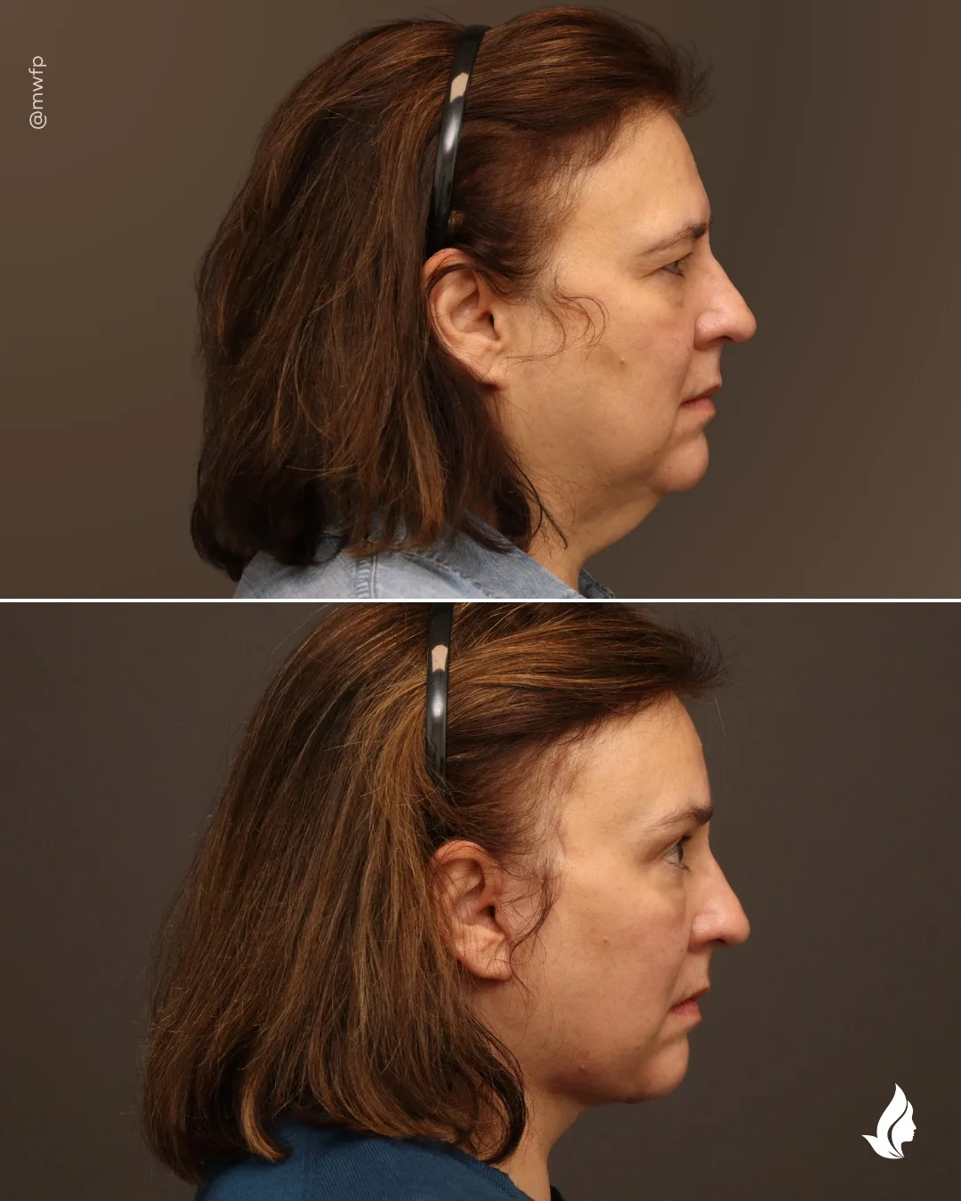 Before and after — Dr. Zachary Farhood
