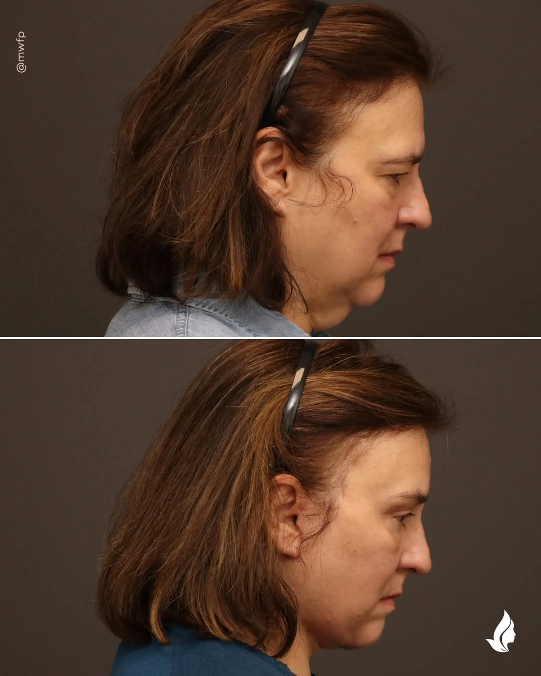 Before and after — Dr. Zachary Farhood