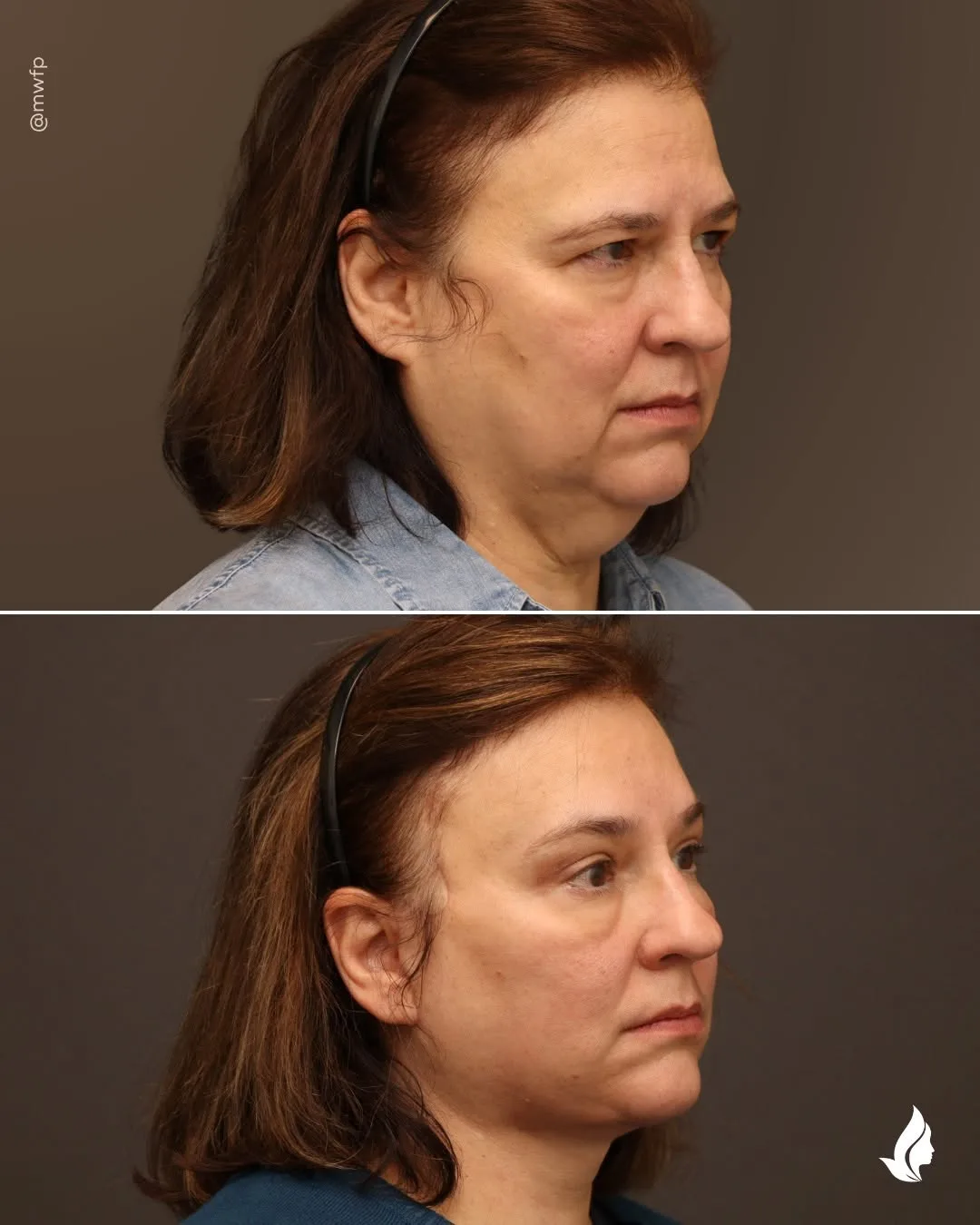 Before and after — Dr. Zachary Farhood