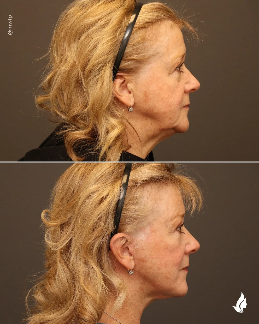 Before and after — Dr. Zachary Farhood