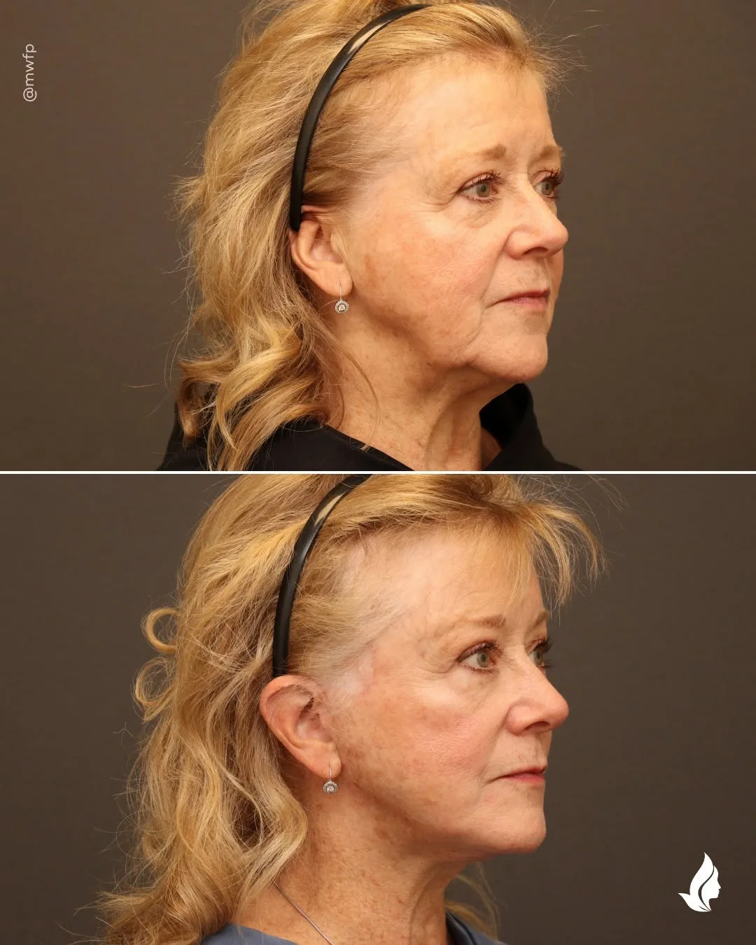 Before and after — Dr. Zachary Farhood