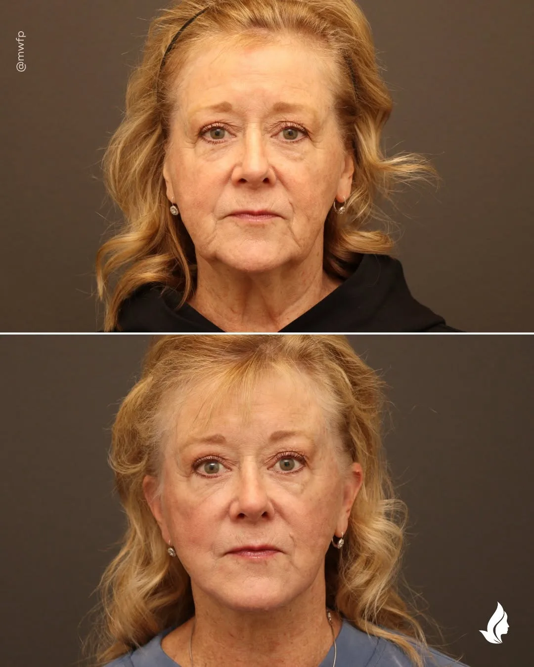 Before and after — Dr. Zachary Farhood