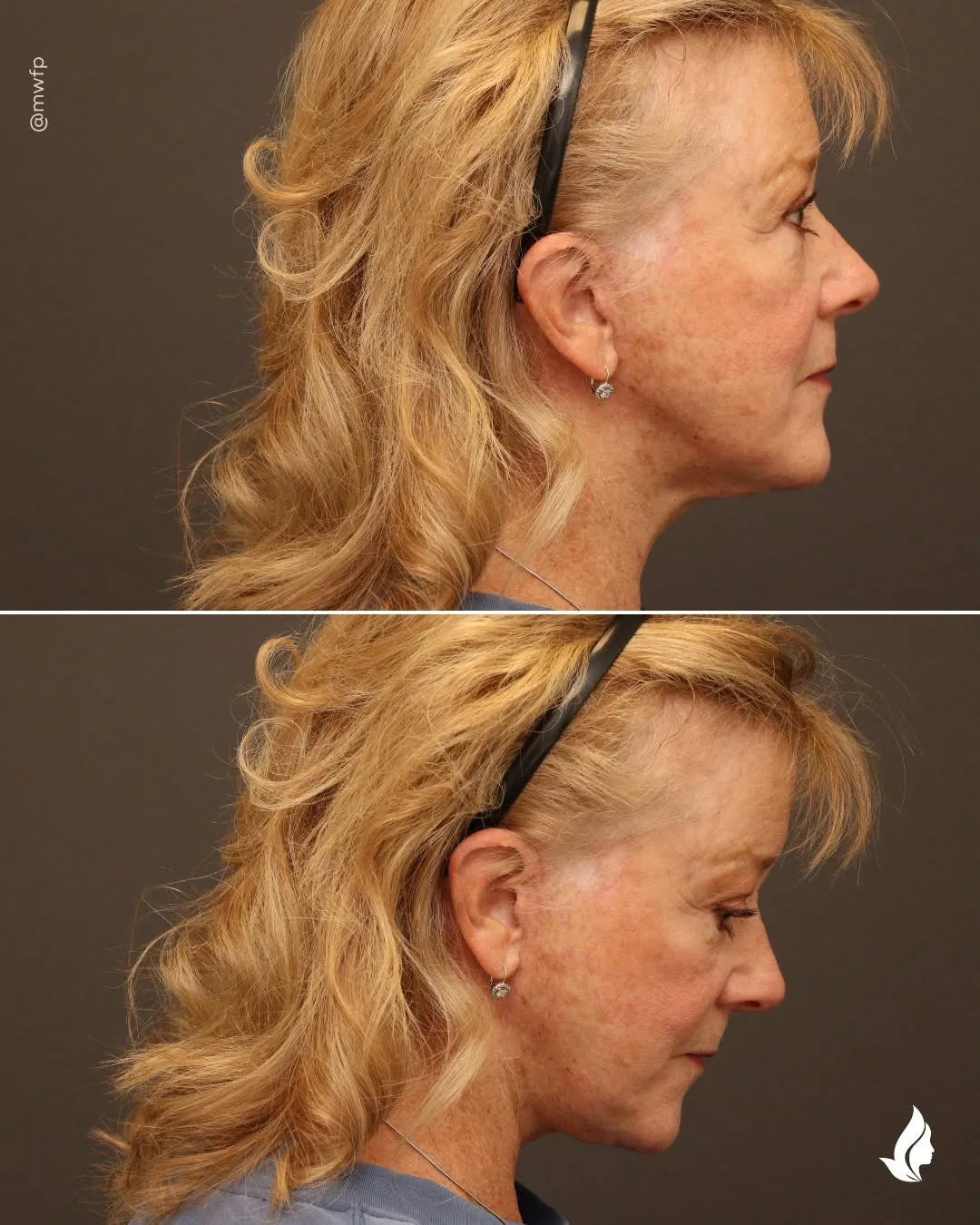 Before and after — Dr. Zachary Farhood