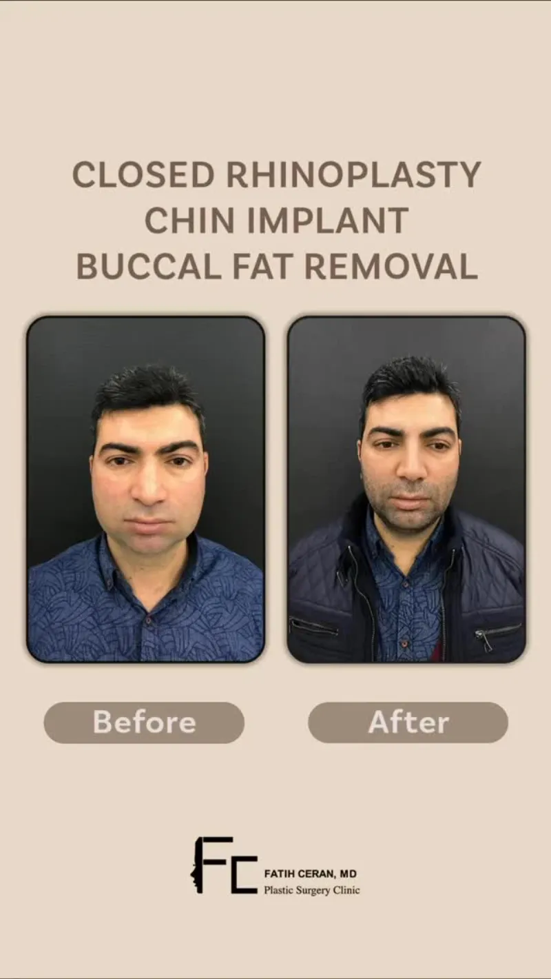 Before and after — Dr. Fatih Ceran