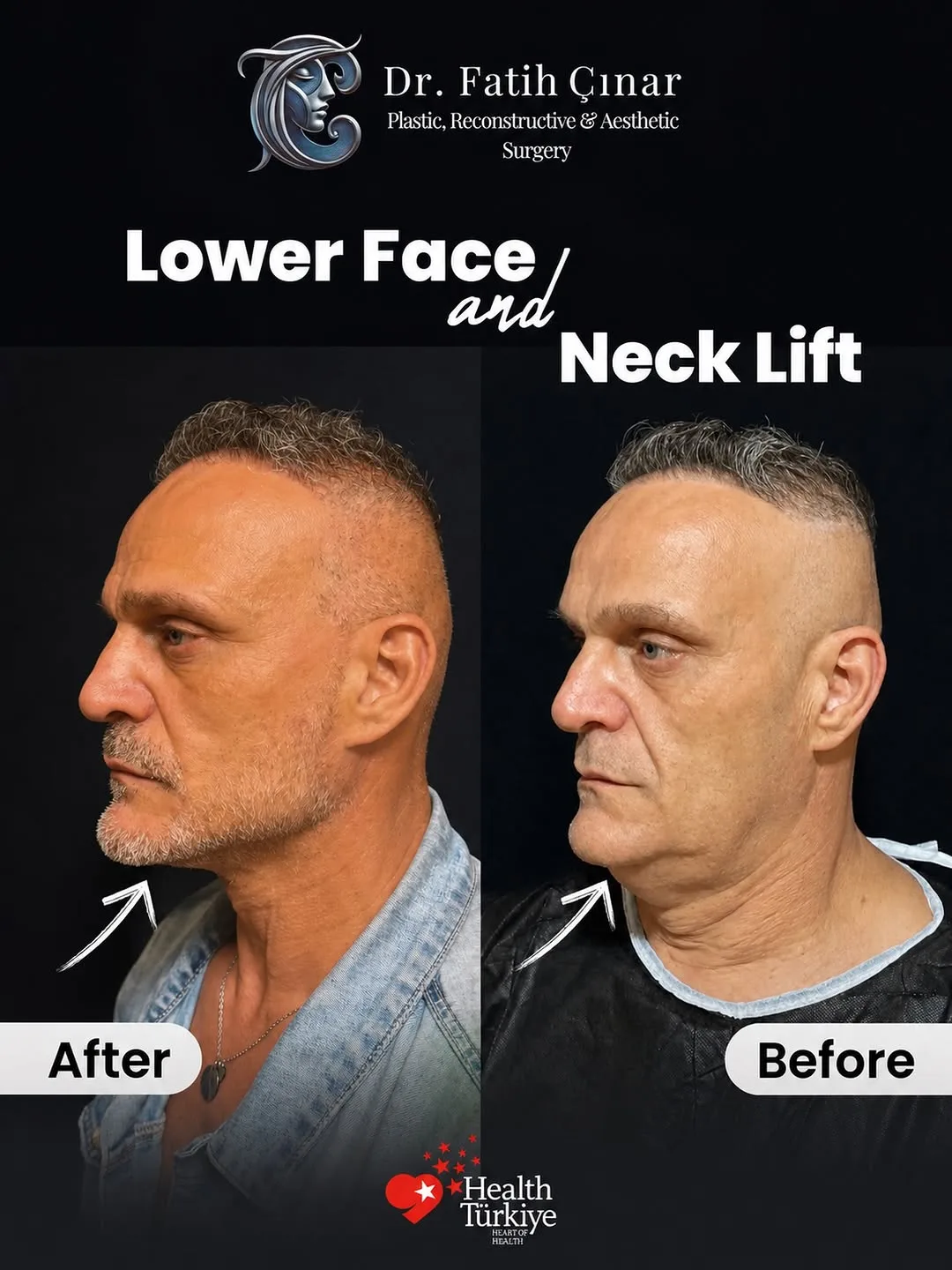 Before and after — Dr. Fatih Çınar