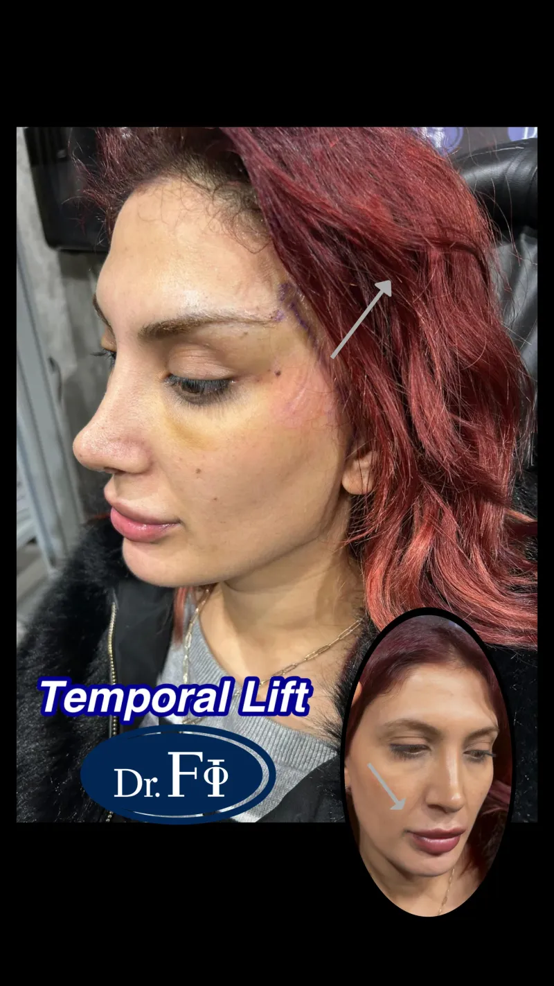 Before and after — Dr. Ferhat İlen
