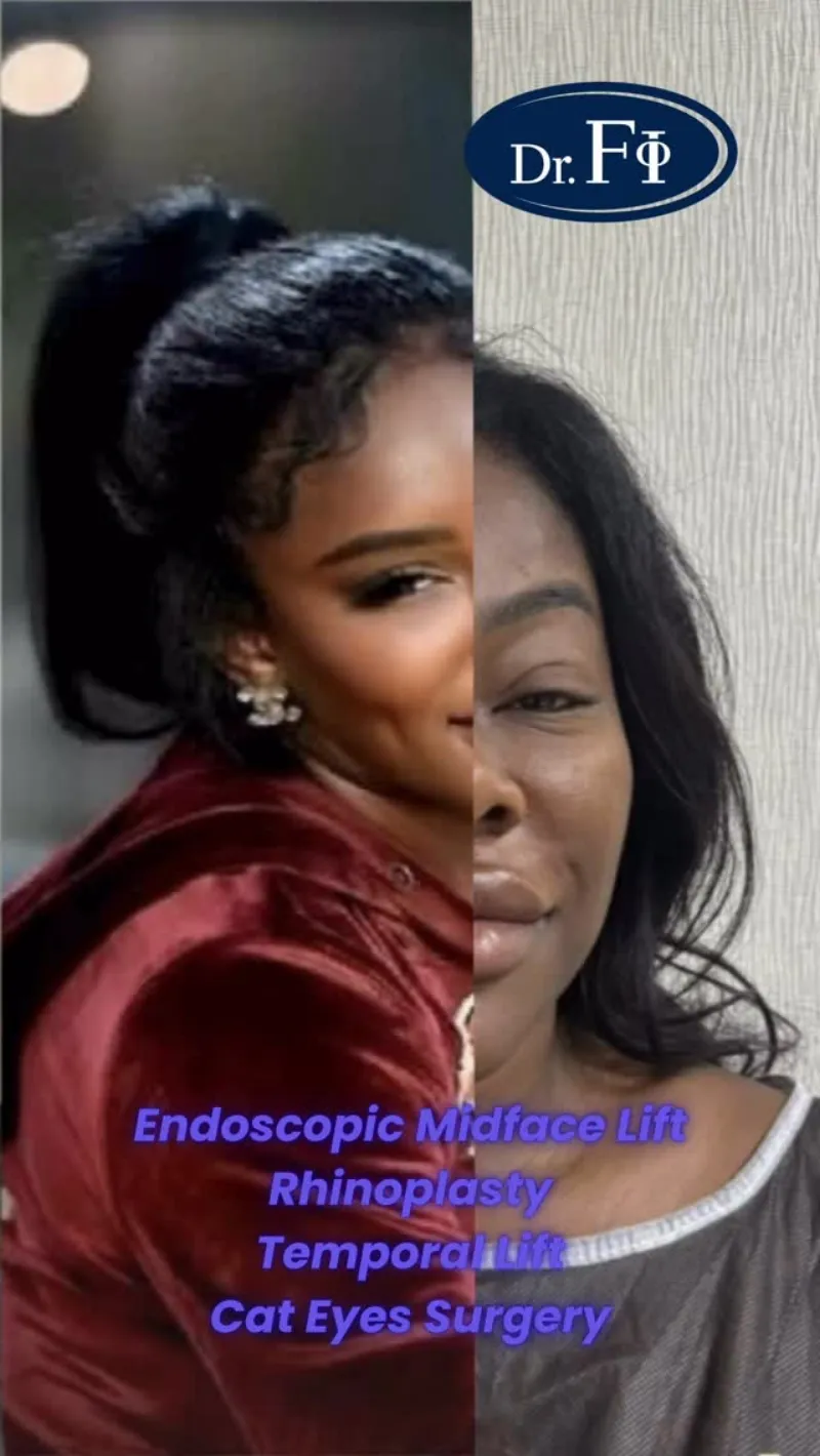 Before and after — Dr. Ferhat İlen