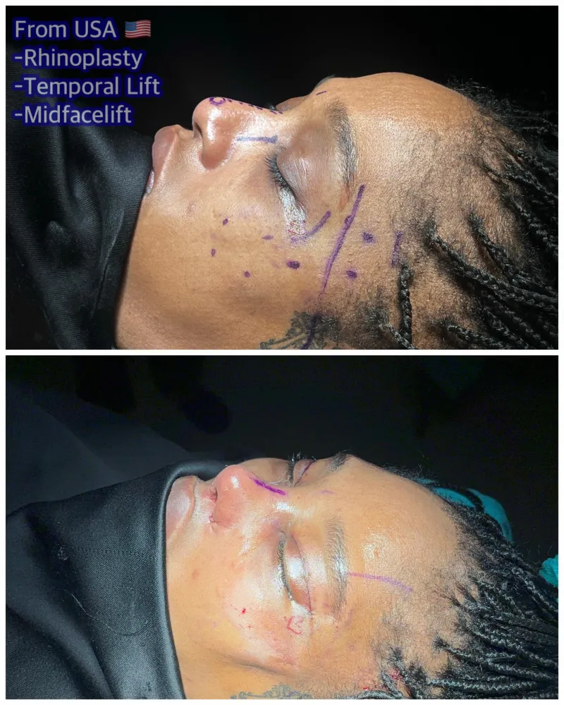 Before and after — Dr. Ferhat İlen