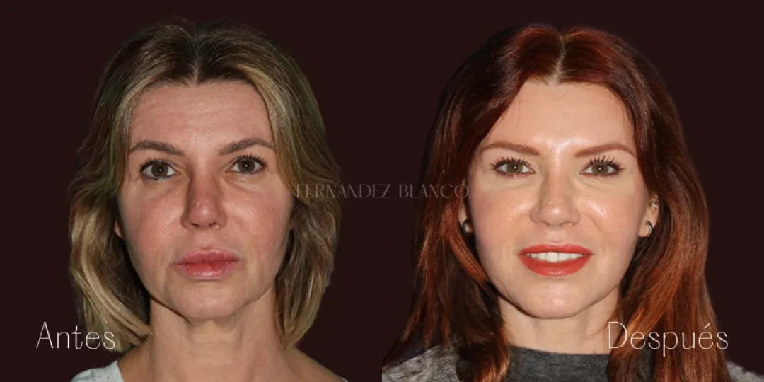 Before and after — Dr. Fernández Blanco