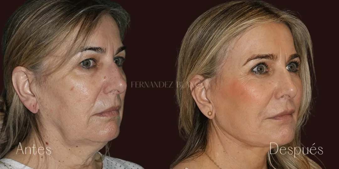 Before and after — Dr. Fernández Blanco