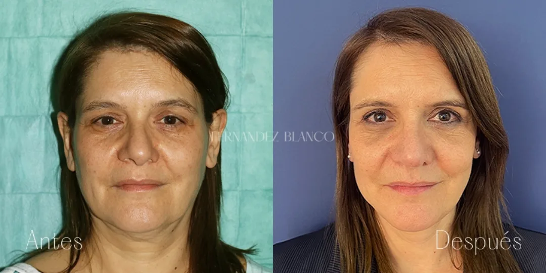 Before and after — Dr. Fernández Blanco