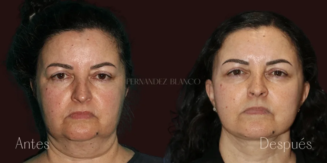 Before and after — Dr. Fernández Blanco