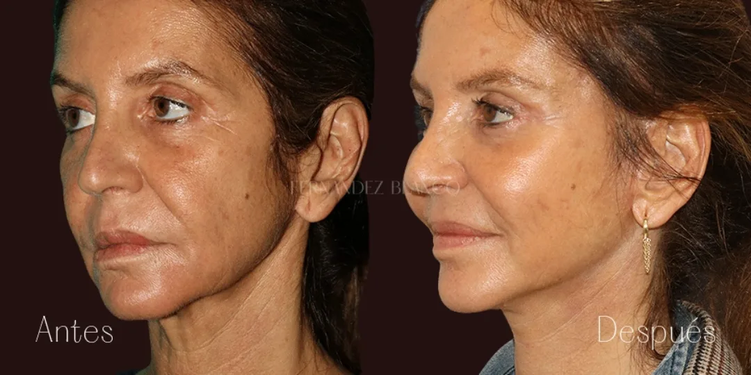 Before and after — Dr. Fernández Blanco