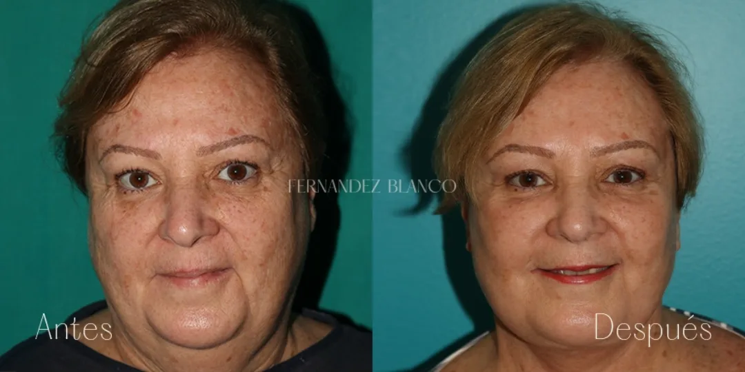 Before and after — Dr. Fernández Blanco