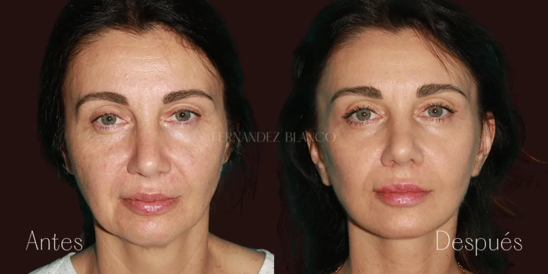 Before and after — Dr. Fernández Blanco