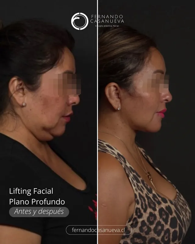 Before and after — Dr. Fernando Casanueva