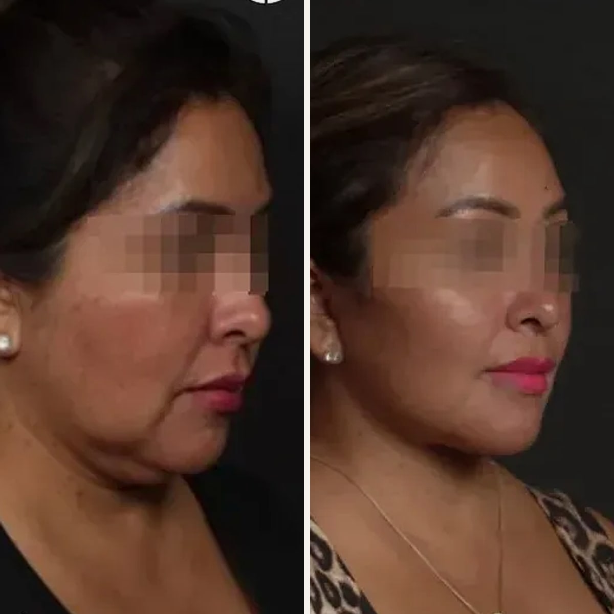 Before and after: Dr. Fernando Casanueva