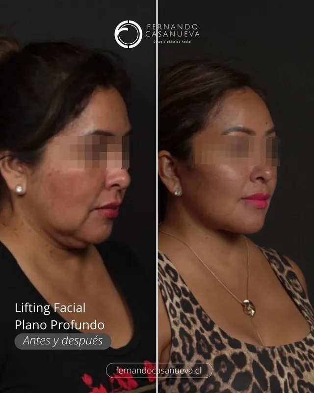Before and after — Dr. Fernando Casanueva
