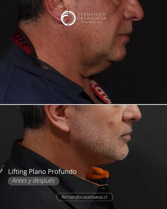 Before and after — Dr. Fernando Casanueva