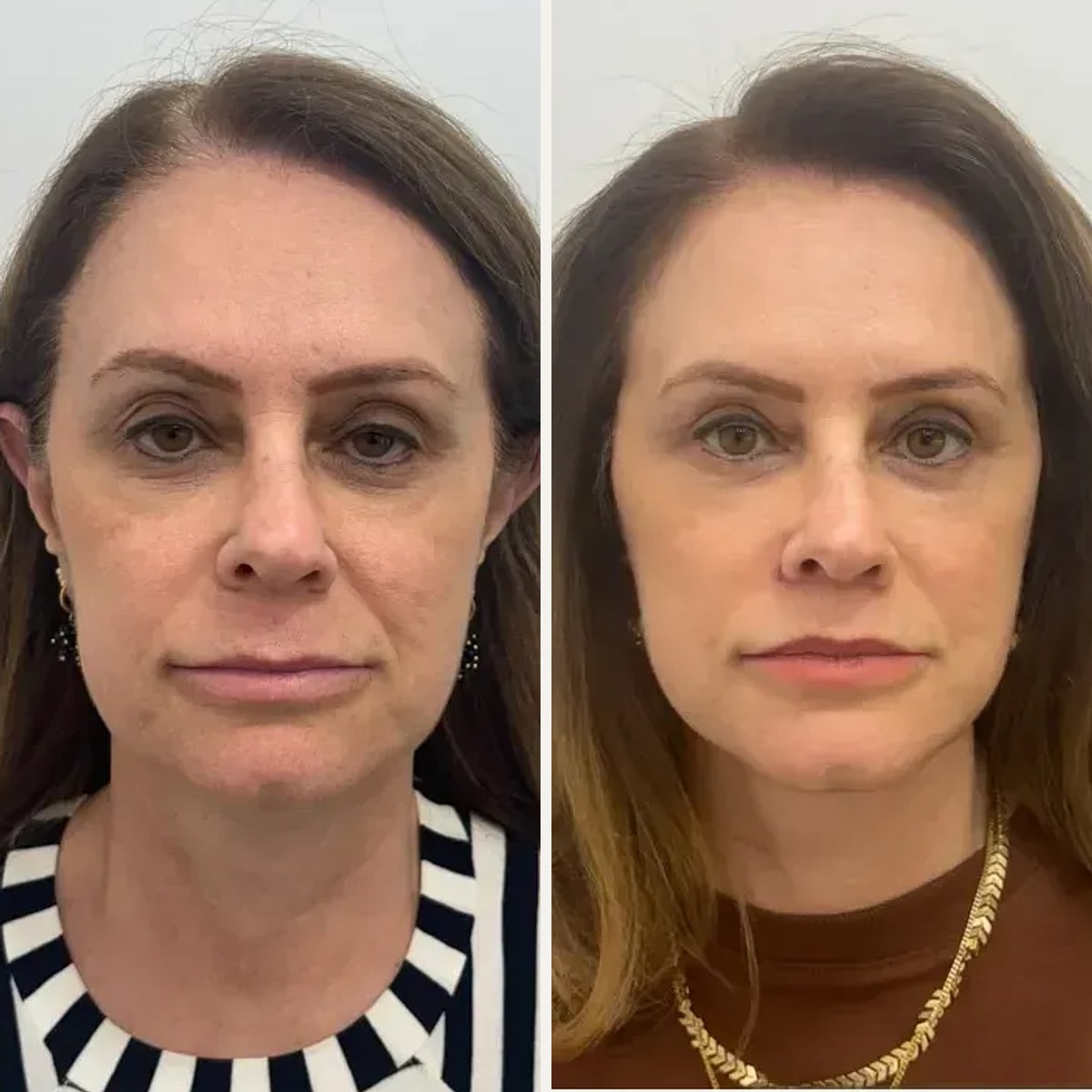 Before & After - Deep Plane Facelift
