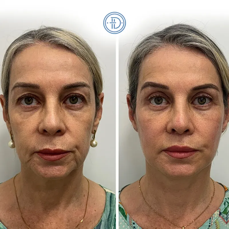 قبل وبعد - Deep Plane Facelift بواسطة د. Fernando Delatti