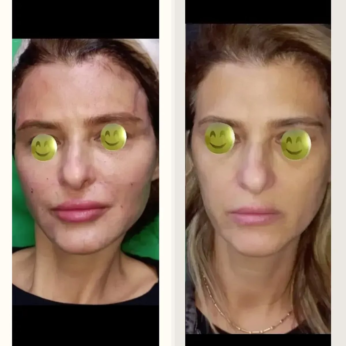 Before & After - Deep Plane Facelift by Dr. Fikret Eren