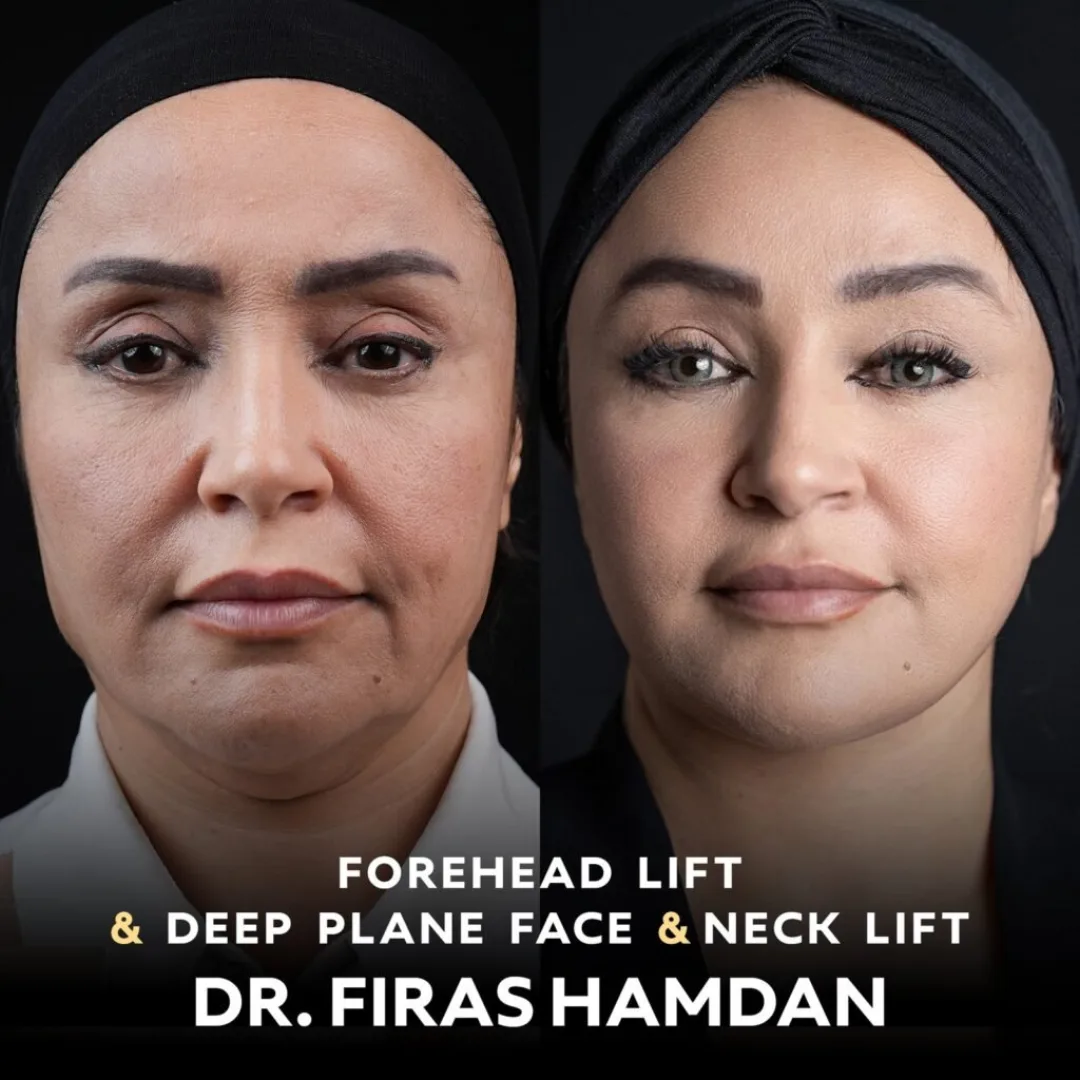 Before and after — Dr. Firas Hamdan
