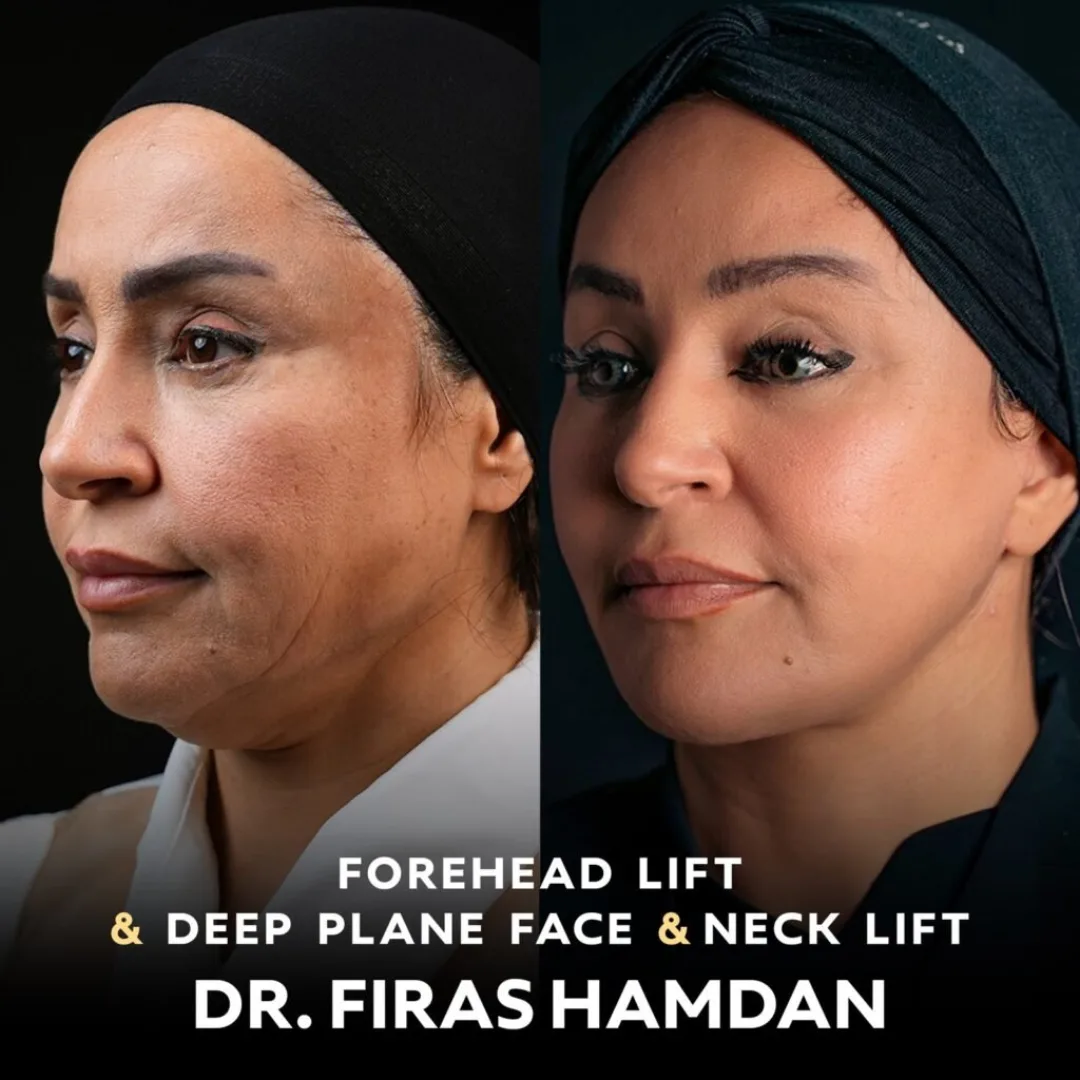 Before and after — Dr. Firas Hamdan
