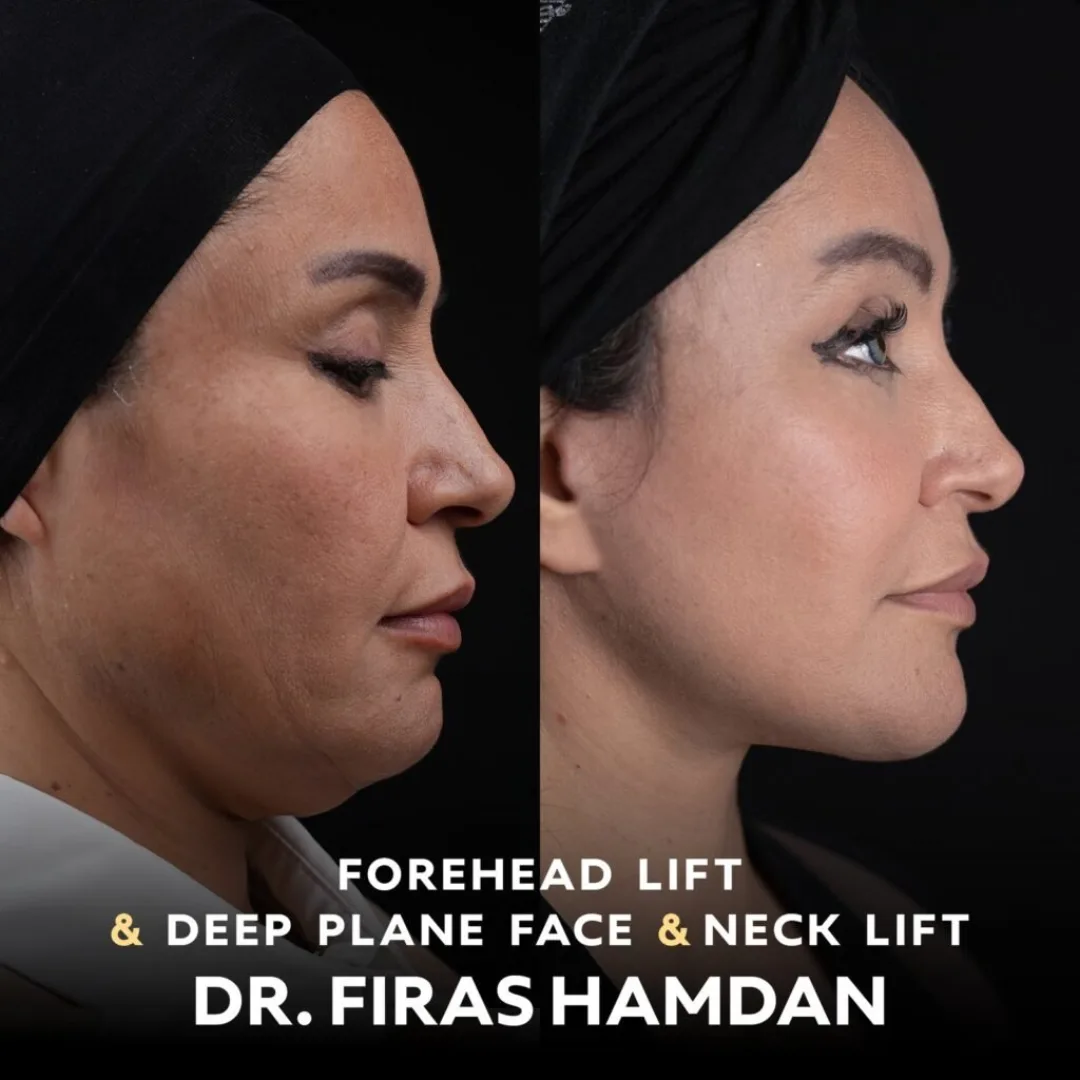 Before and after — Dr. Firas Hamdan