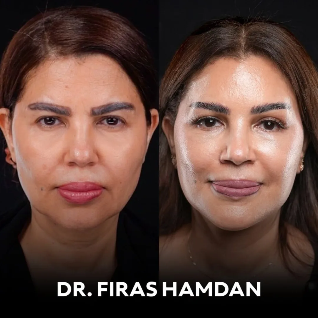 Before and after — Dr. Firas Hamdan