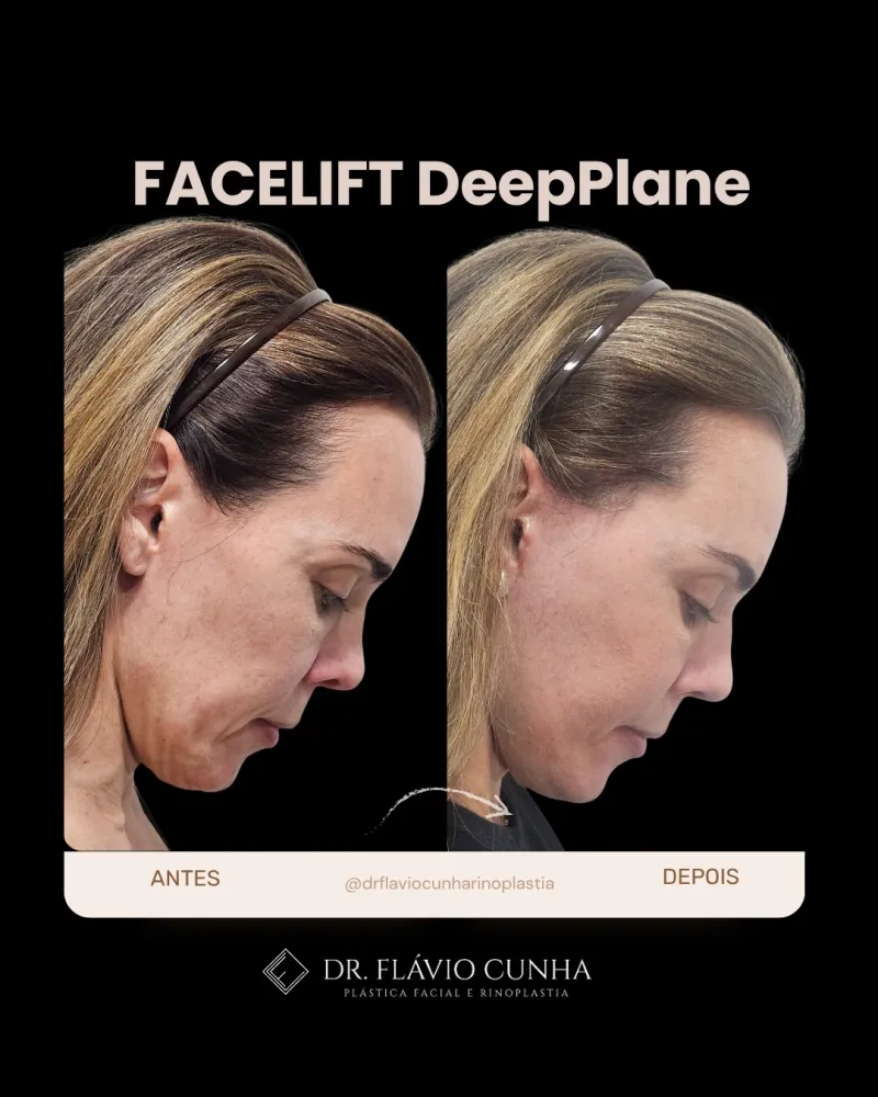 Before and after: Dr. Flavio Cunha Ferreira