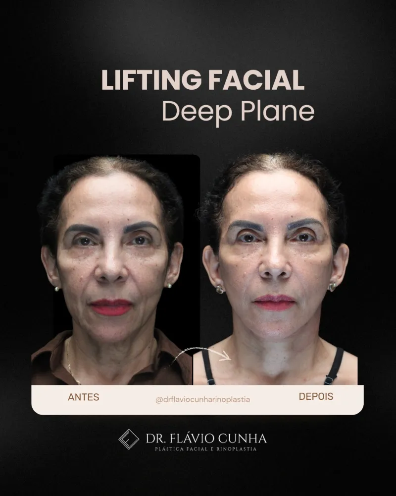 Before and after: Dr. Flavio Cunha Ferreira