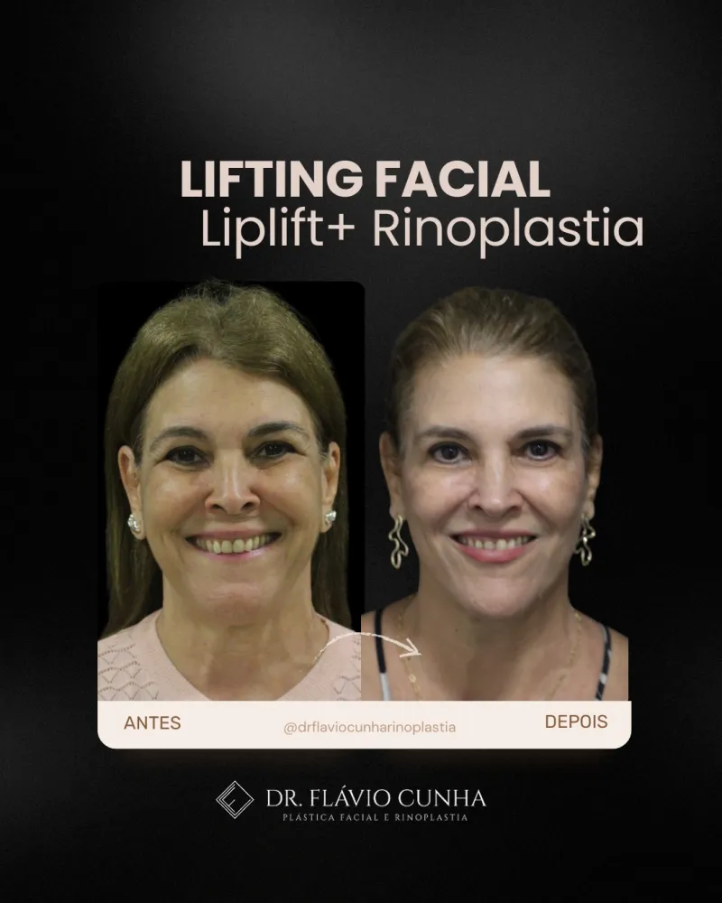 Before and after: Dr. Flavio Cunha Ferreira
