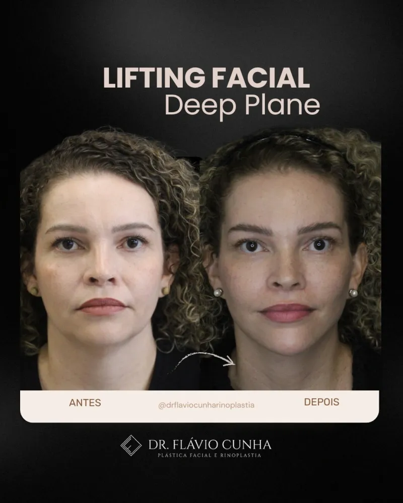Before and after: Dr. Flavio Cunha Ferreira