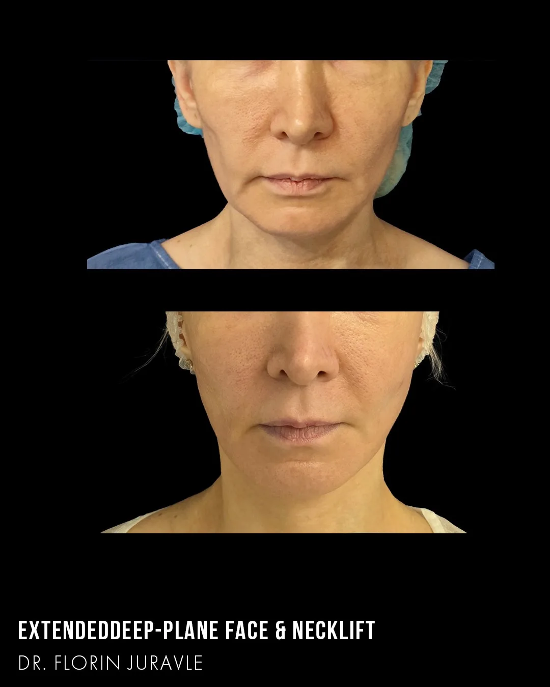 Before and after — Dr. Florin Juravle