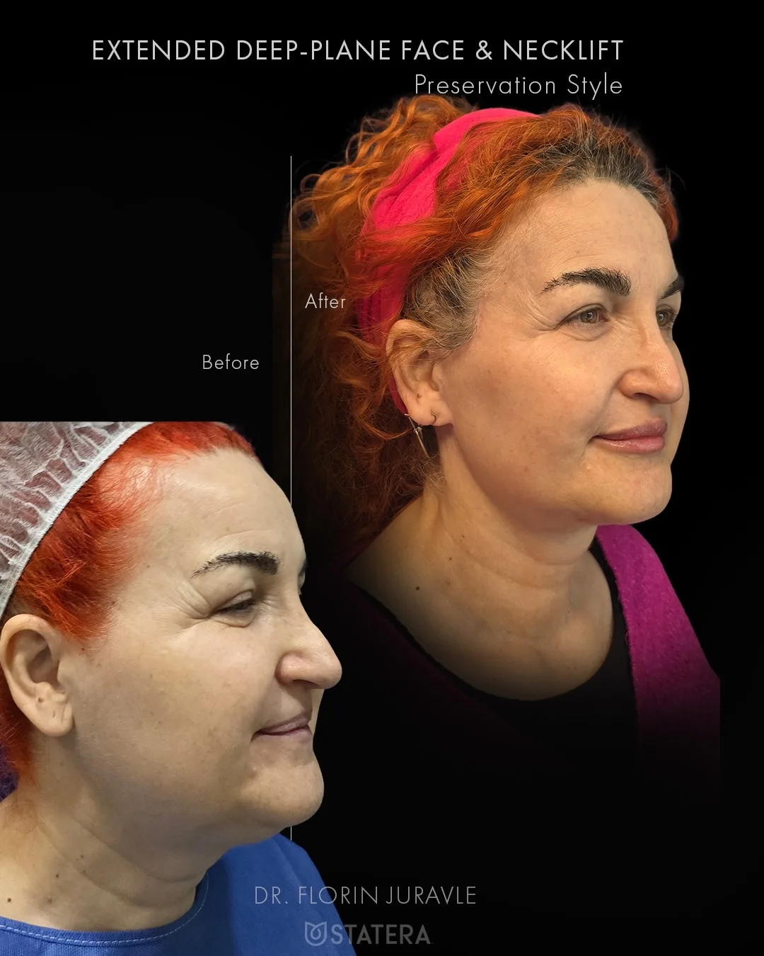 Before and after — Dr. Florin Juravle