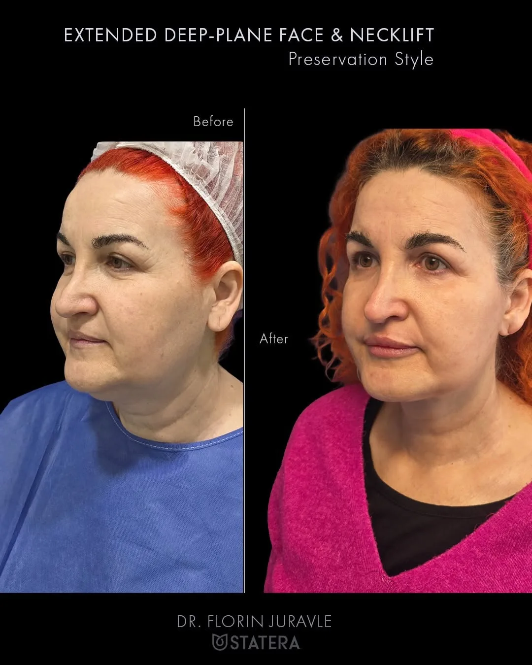 Before and after — Dr. Florin Juravle